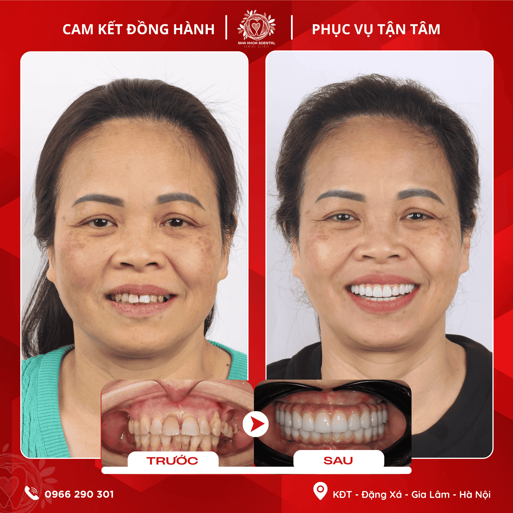 Hành Trình Tái Sinh Nụ Cười All-On-4 Của Cô Nguyễn Thị Thúy Bình Tại Nha Khoa S-Dental